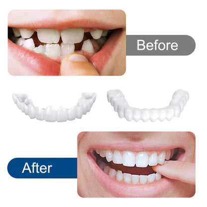 Snap-On Smile Removable Dental Veneers